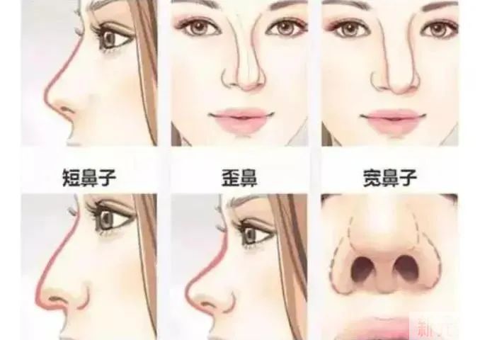鼻修复之前，必须了解的靠谱知识! 图片-5