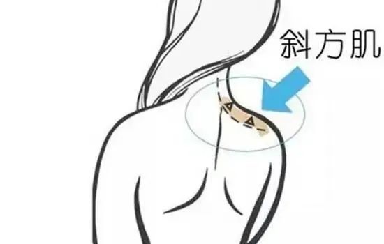 瘦肩针---轻松拥有迷人一字肩 图片-2