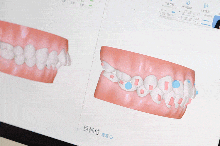 【必看】内行揭秘牙齿矫正全流程，附矫治器选择和矫正费用参考! 图片-5