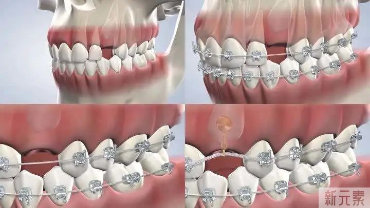 【必看】内行揭秘牙齿矫正全流程，附矫治器选择和矫正费用参考! 图片-7
