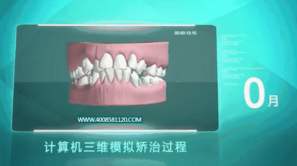 【必看】内行揭秘牙齿矫正全流程，附矫治器选择和矫正费用参考! 图片-12