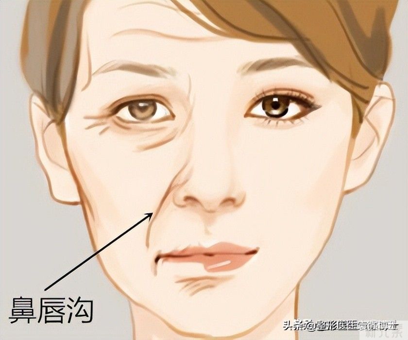 想摆脱“法令纹”，医生揭秘几点真相，一般人不会说 图片-1