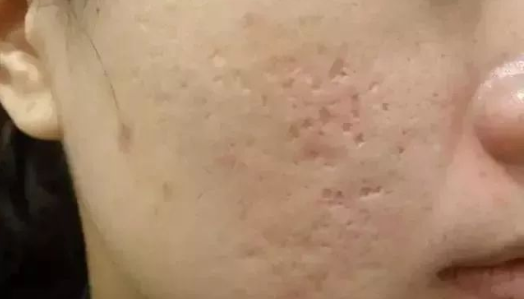 凹陷疤痕居然有5种类型，你是哪一种? 图片-9