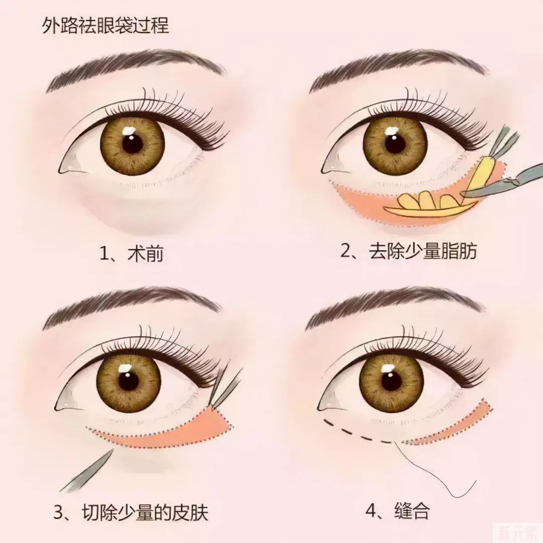 这两种方式祛不了眼袋，别再花冤枉钱了 图片-9