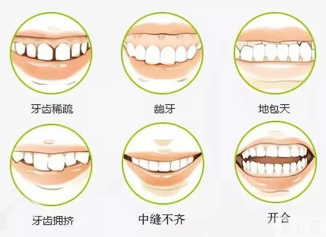 牙齿矫正科普，速来围观! 图片-5