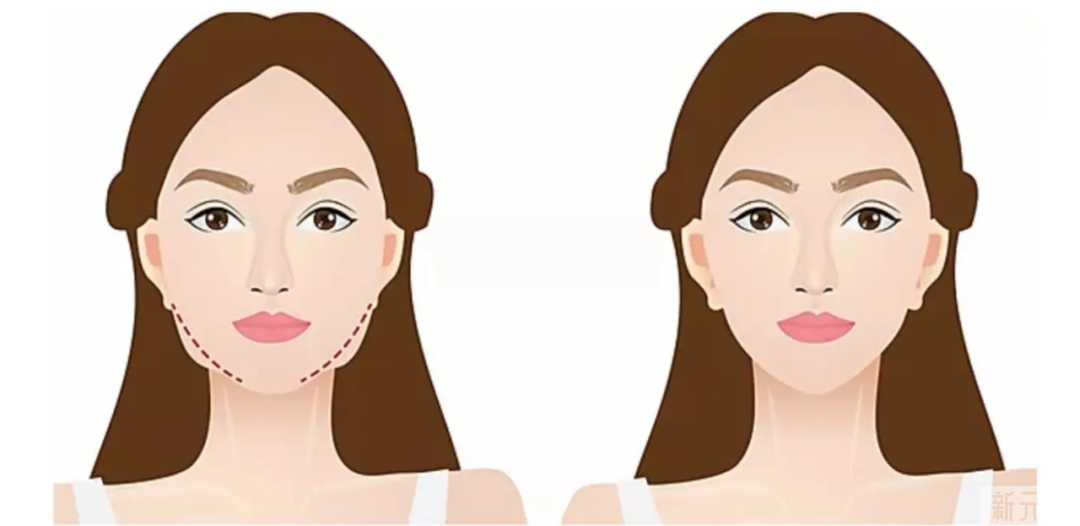 瘦脸之后竟然会出现这种情况?! 图片-1