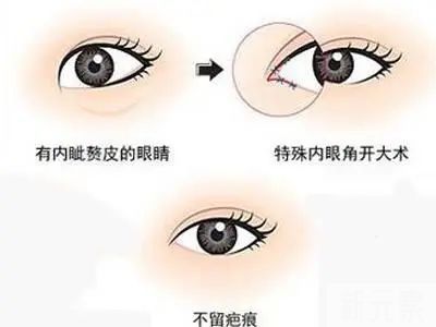 这8大眼部缺陷，割个双眼皮就能改善! 图片-5