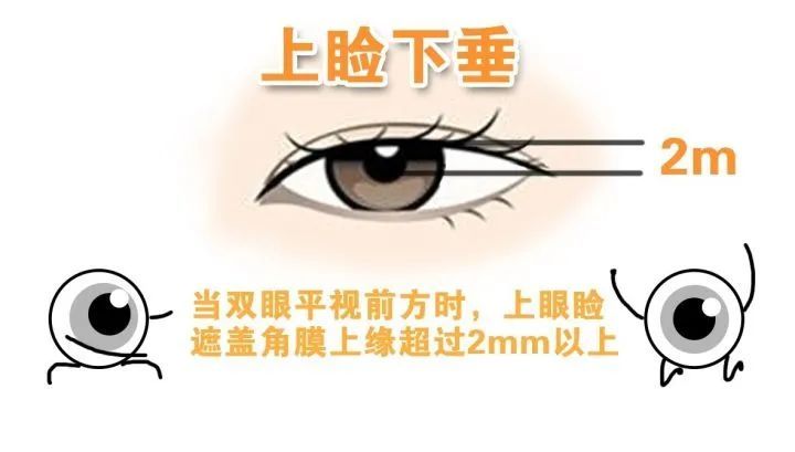 这8大眼部缺陷，割个双眼皮就能改善! 图片-8