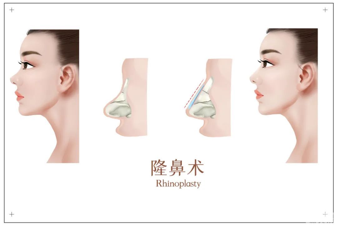 还在想怎么隆鼻?保姆级隆鼻攻略在这里! 图片-6
