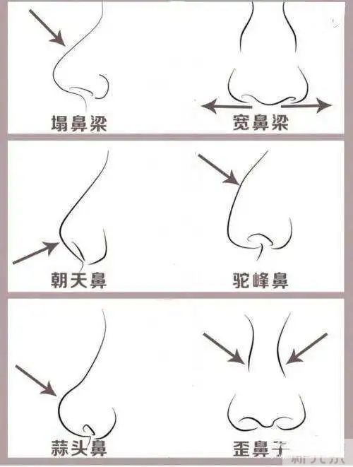 还在想怎么隆鼻?保姆级隆鼻攻略在这里! 图片-5