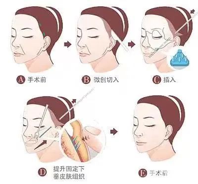 MINI除皱术与大拉皮手术的区别是什么? 图片-18