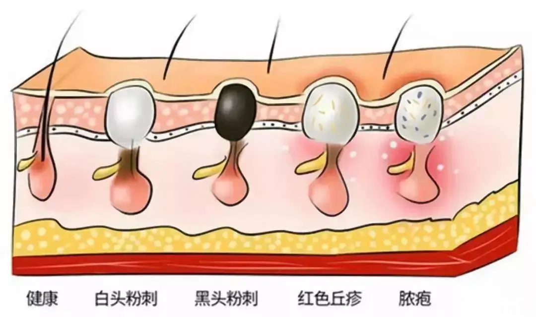 反复长痘的“痘痘肌”，很可能是你自己“作”出来的! 图片-5