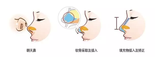 蒜头鼻、朝天鼻、鹰钩鼻...鼻头难看怎么破? 图片-8