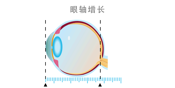 近视1100°的热巴，为啥要在做激光前割双眼皮? 图片-6
