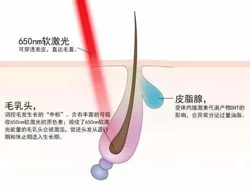 激光治脱发，这个技术能处! 图片-2