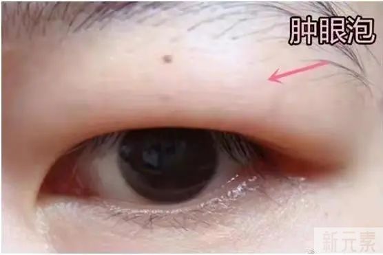 想做双眼皮手术?这些干货你要知道 图片-13