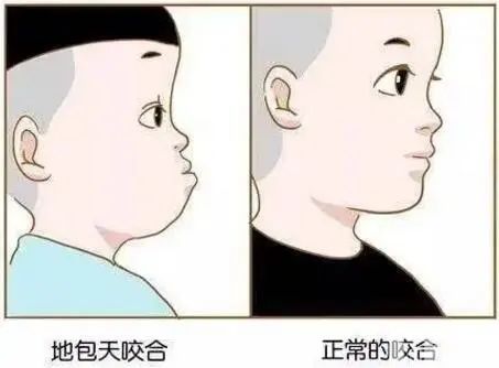 科普 | 地包天错过最佳治疗时机怎么办? 图片-4