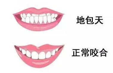 科普 | 地包天错过最佳治疗时机怎么办? 图片-8