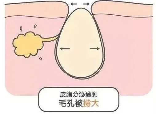 对症下药缩毛孔，看这篇就够了...... 图片-5