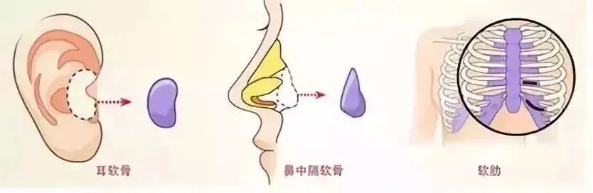 隆鼻术那么多种，到底该怎么选? 图片-5