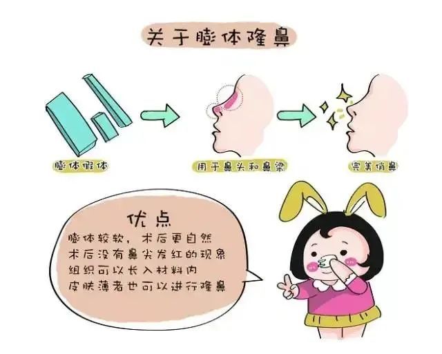 隆鼻术那么多种，到底该怎么选? 图片-3