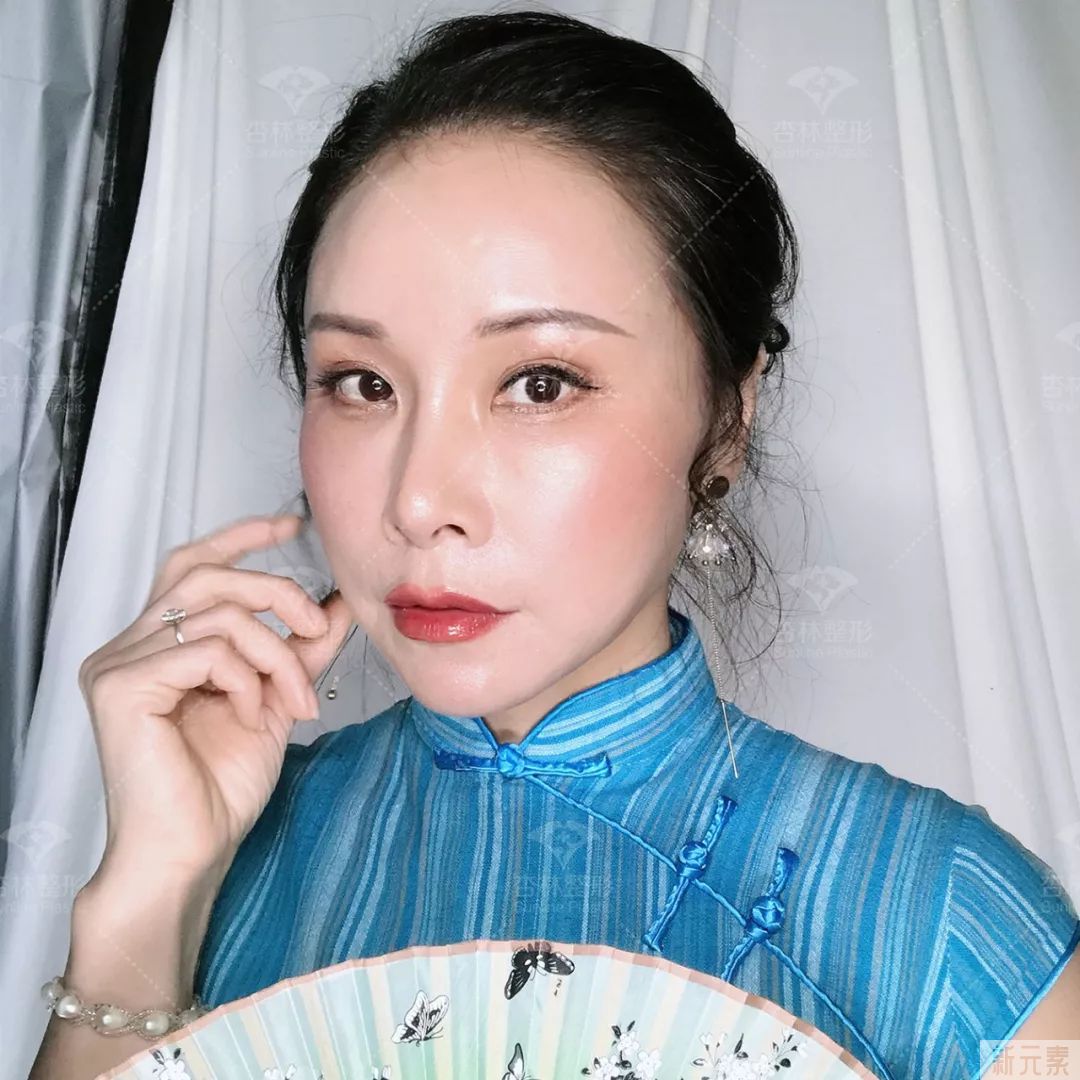 眼皮松弛?大眼袋?悬眉+祛眼袋一招搞定! 图片-5