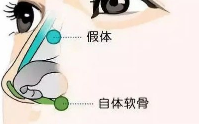 隆鼻术那么多种，到底该怎么选? 图片-6