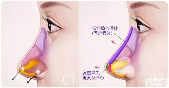 隆鼻自然不违和的秘诀!这样做，“ 后天翘鼻” 也能宛若ma生! 图片-2