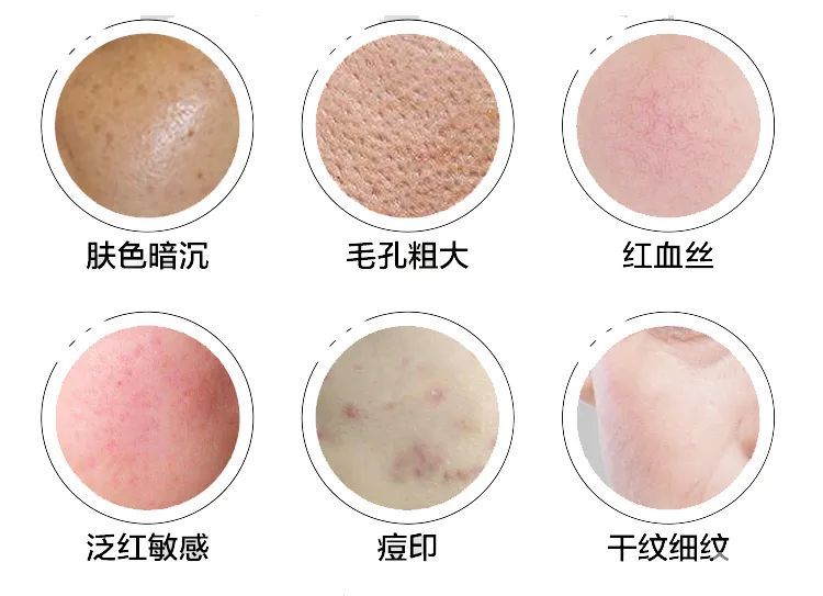 不同年龄段做光子嫩肤应该怎么选? 图片-7