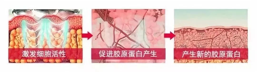 不同年龄段做光子嫩肤应该怎么选? 图片-13