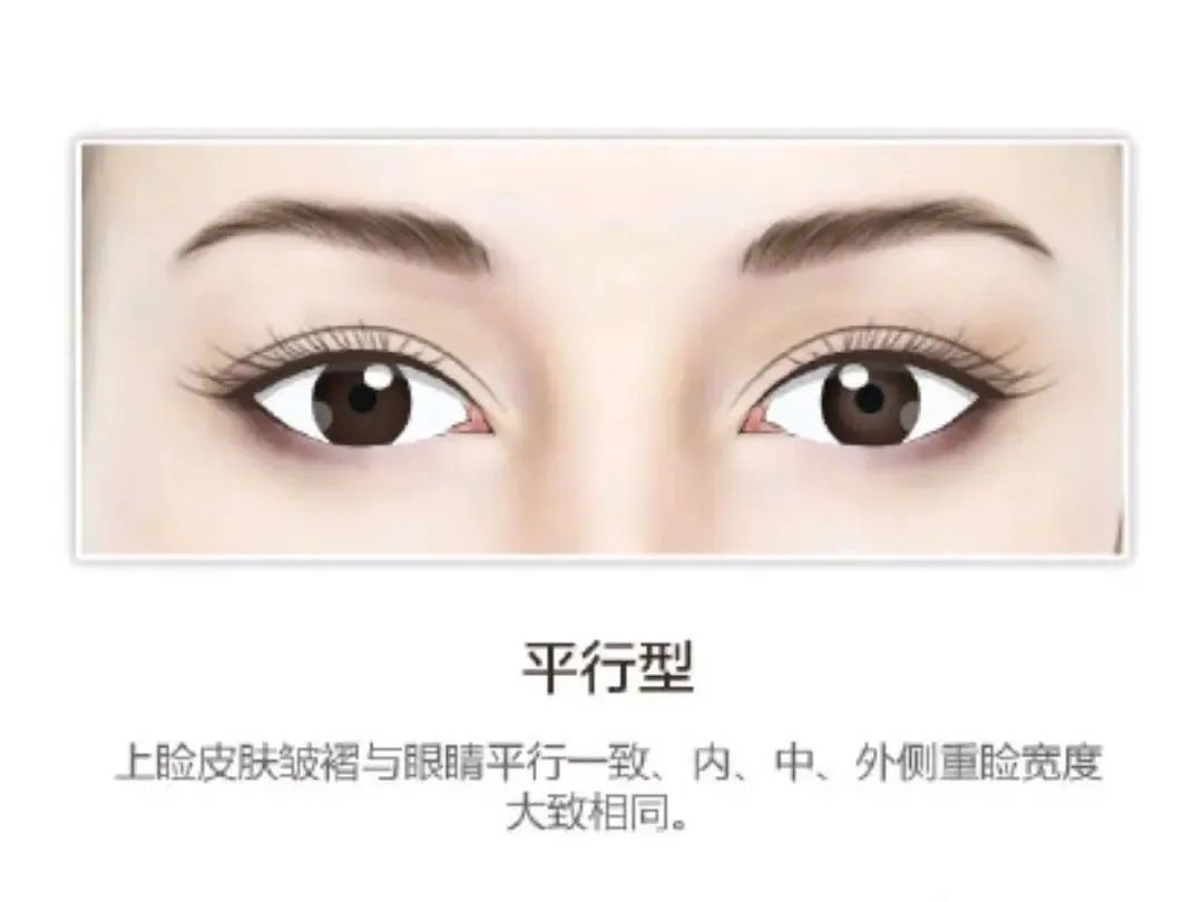 割双眼皮前，你需要做好这些攻略 图片-7