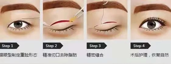 割双眼皮前，你需要做好这些攻略 图片-4