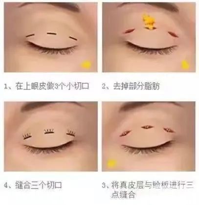 割双眼皮前，你需要做好这些攻略 图片-6