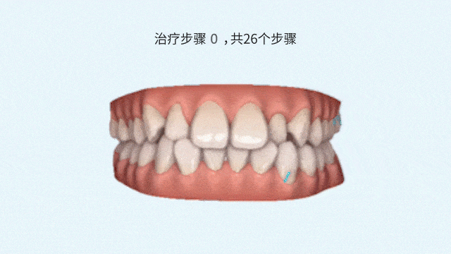 你还在纠结矫牙选传统矫正和隐形矫正?答案都在此! 图片-7