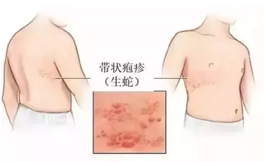 让人闻听色变的带状疱疹，会不会留疤呢? 图片-3