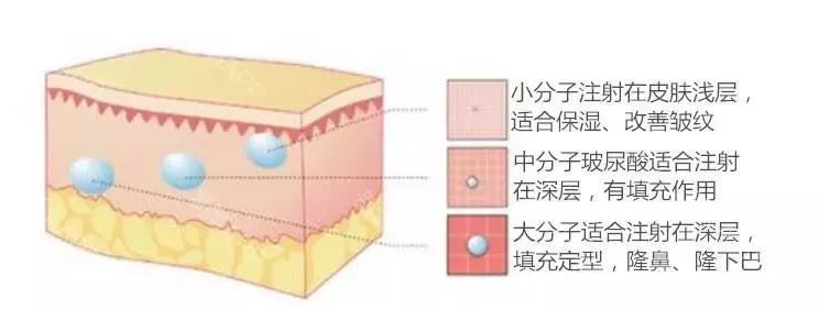 打玻尿酸，是不是越贵就越好? 图片-3