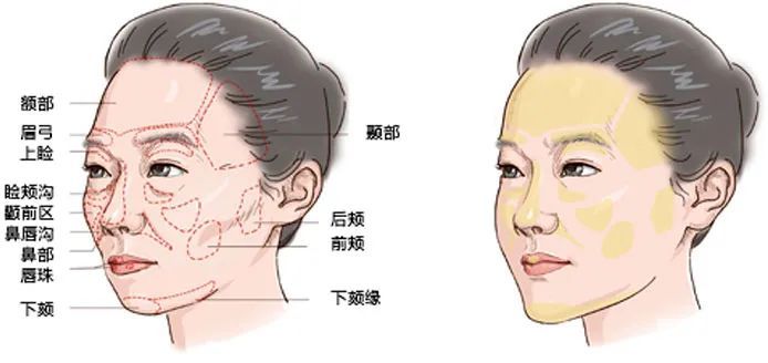 打玻尿酸，是不是越贵就越好? 图片-7