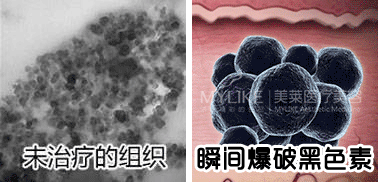 范bb小红书力荐的皮秒，真的让人白到发光! 图片-8