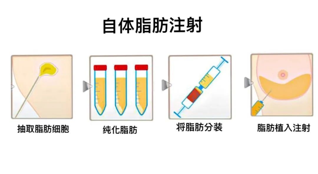 吸脂误区全解析 图片-6