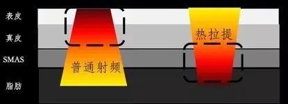 热拉提PLUS凭什么叫“mini热玛吉”? 图片-4