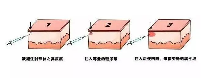 法令纹越来越深怎么办? 图片-8