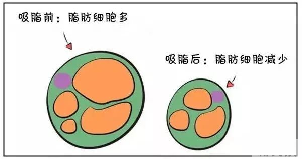 关于吸脂，你们关心的问题都在这里! 图片-10