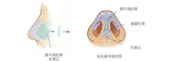 耳软骨&鼻中隔软骨&肋软骨隆鼻有什么区别?如何选择? 图片-7