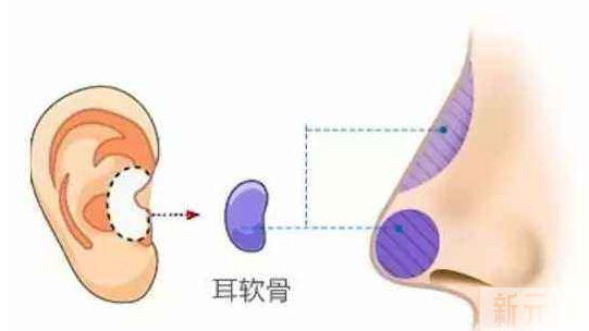 耳软骨&鼻中隔软骨&肋软骨隆鼻有什么区别?如何选择? 图片-5