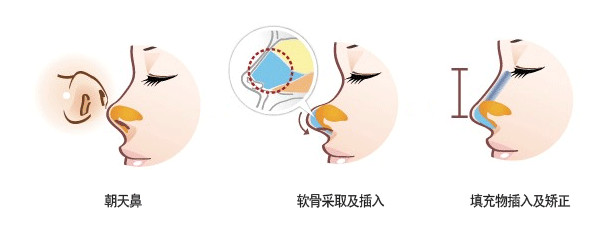 耳软骨&鼻中隔软骨&肋软骨隆鼻有什么区别?如何选择? 图片-8