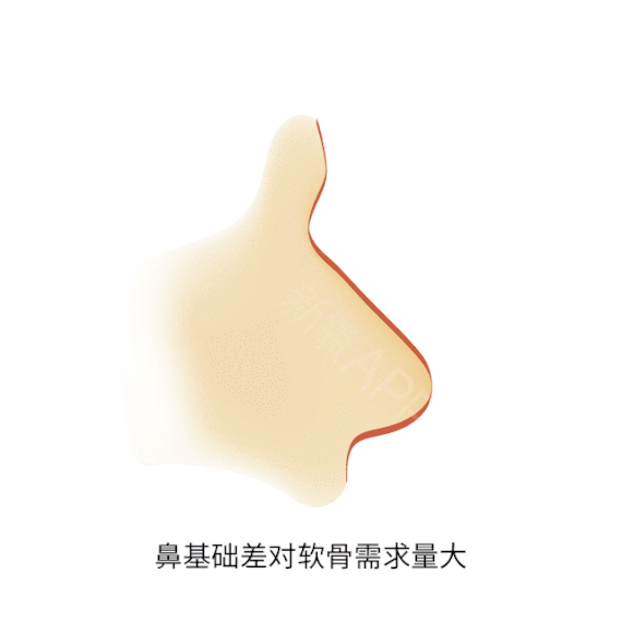 耳软骨&鼻中隔软骨&肋软骨隆鼻有什么区别?如何选择? 图片-10