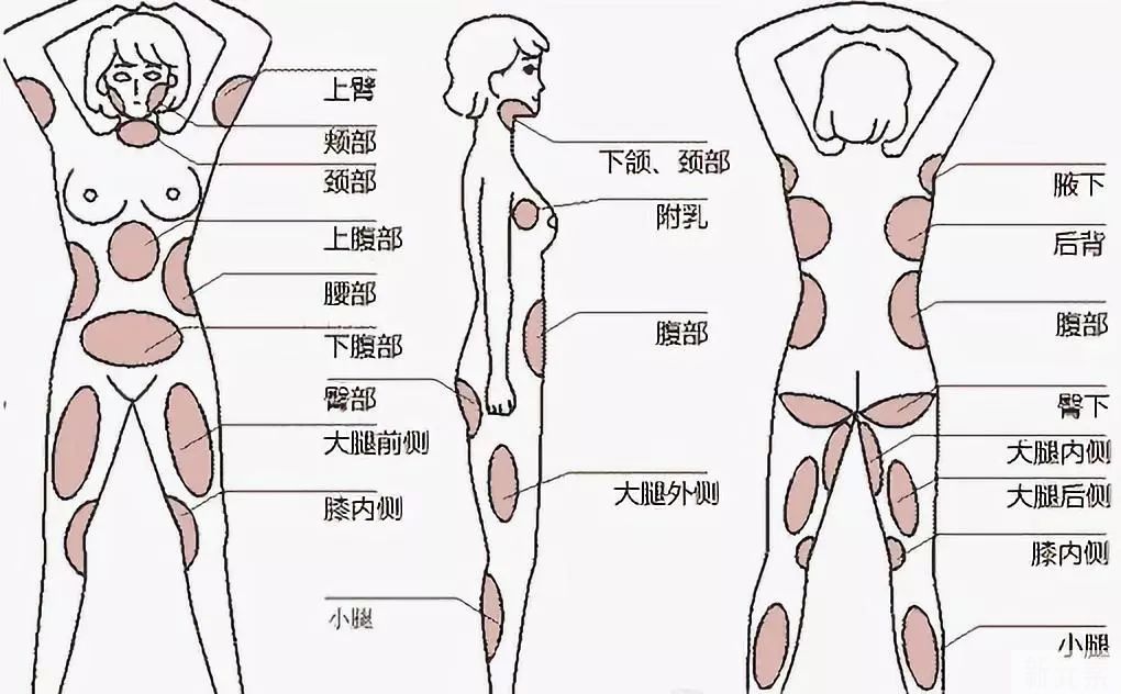 瘦瘦瘦—什么是吸脂?你真的了解吗? 图片-5
