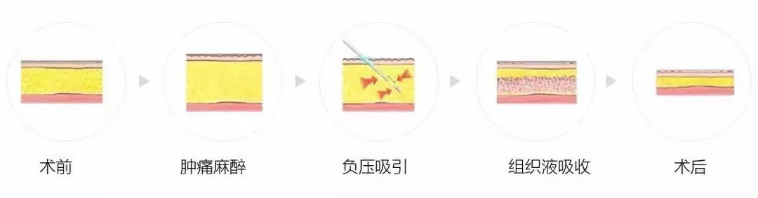 瘦瘦瘦—什么是吸脂?你真的了解吗? 图片-3