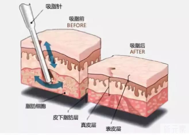 瘦瘦瘦—什么是吸脂?你真的了解吗? 图片-4