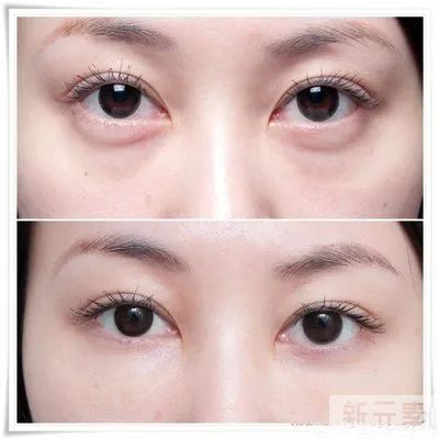 【医美小科普】去眼袋有哪些误区? 图片-2